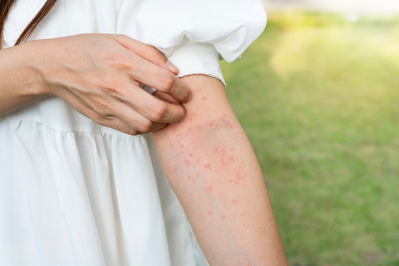 heat rash common skin rashes in summer